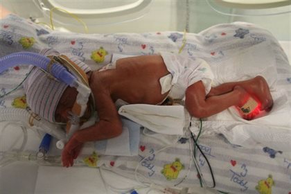 Karen was born at 25 weeks gestation at Mater Mothers' Hospital. Image supplied.